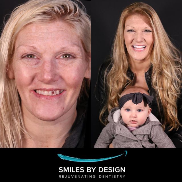 Smile Makeover Single Implants