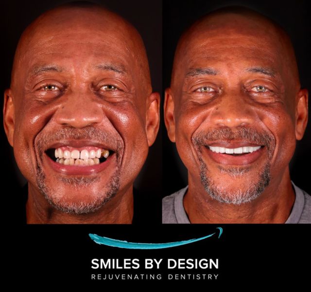 Smile Makeover Overdenture
