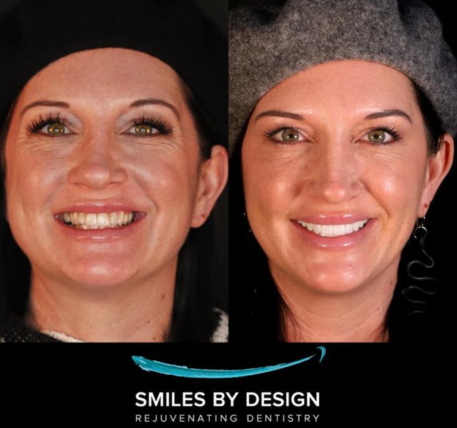 Smile Makeover Fixed Denture