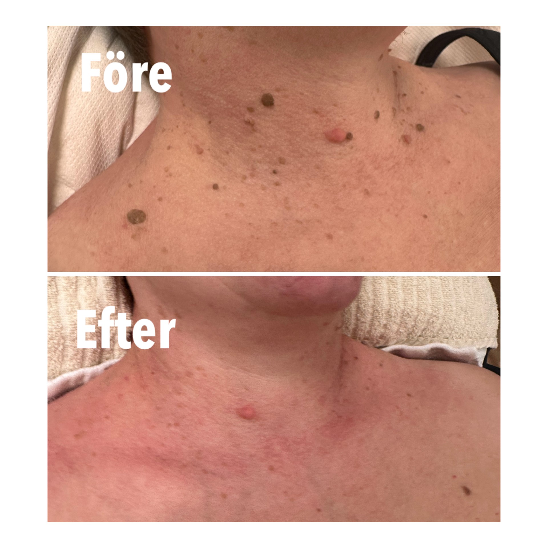 Före och efter – exempel 2
