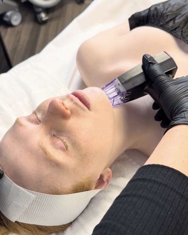 Morpheus8 Treatment