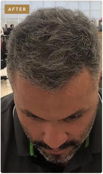After hair restoration