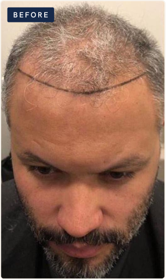 Before hair restoration