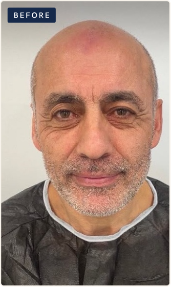 Before hair restoration
