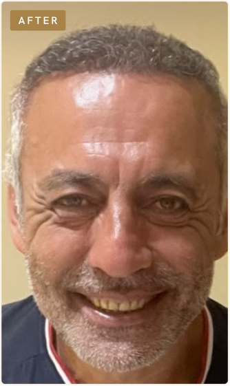 After hair restoration