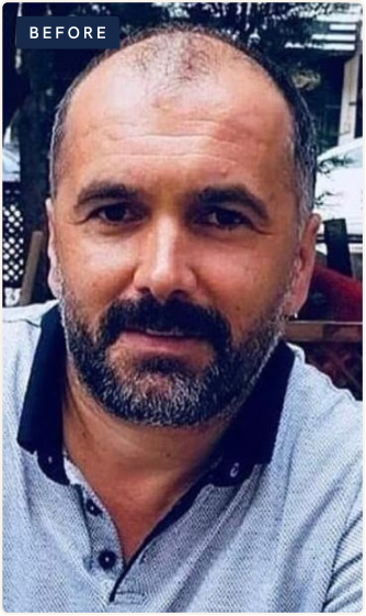 Before hair restoration