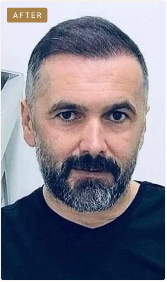 After hair restoration
