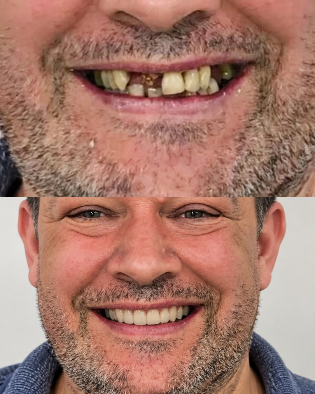 Before and after of a patient's new smile