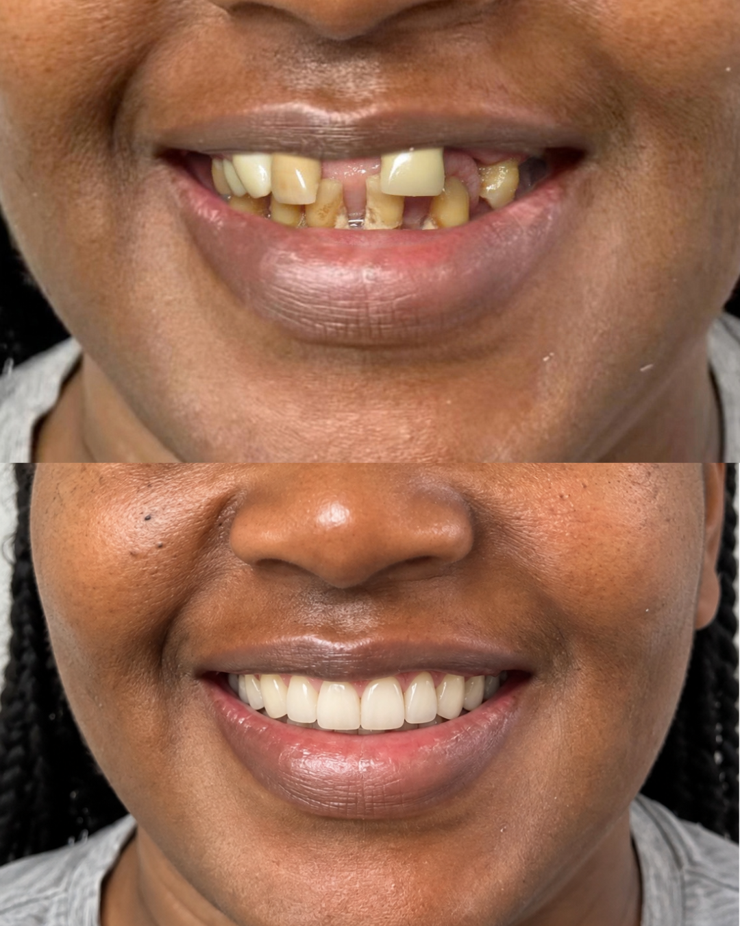 Before and after of a patient's new smile