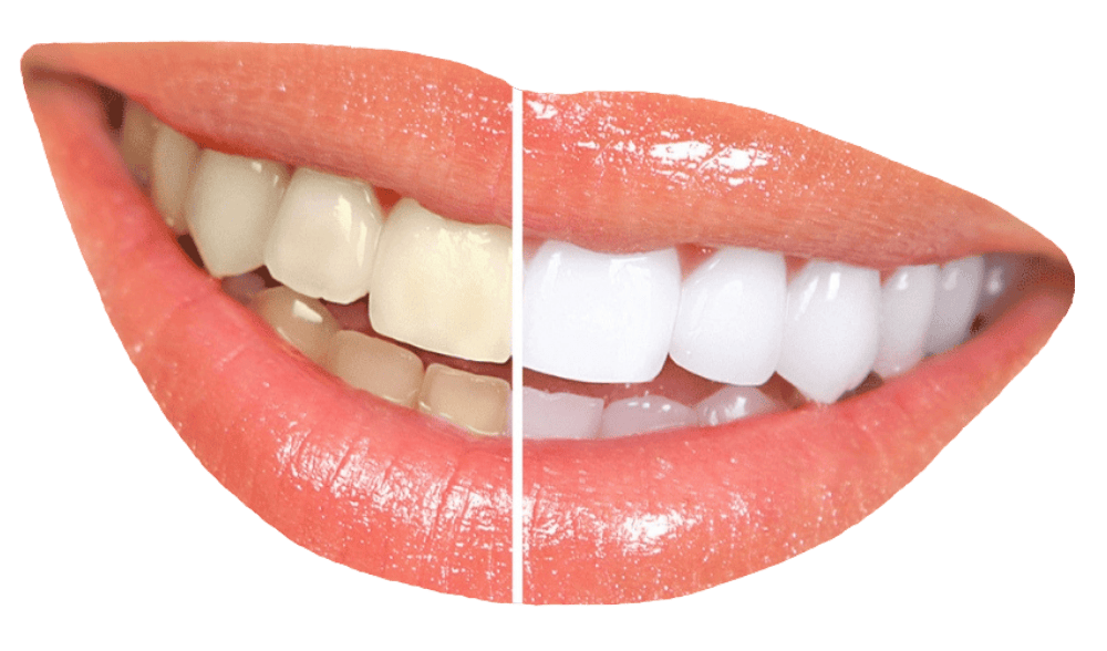 Professional Teeth Whitening Auckland