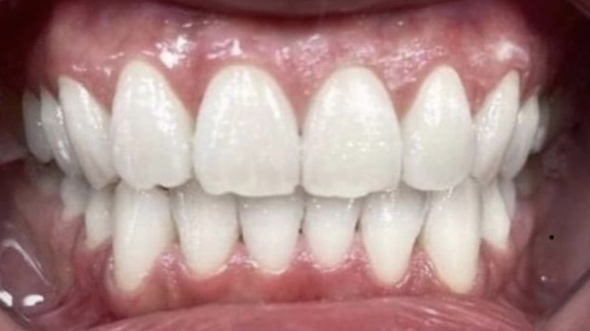 close up of yellow teeth after whitening