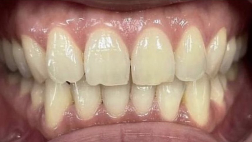 close up of yellow teeth before whitening