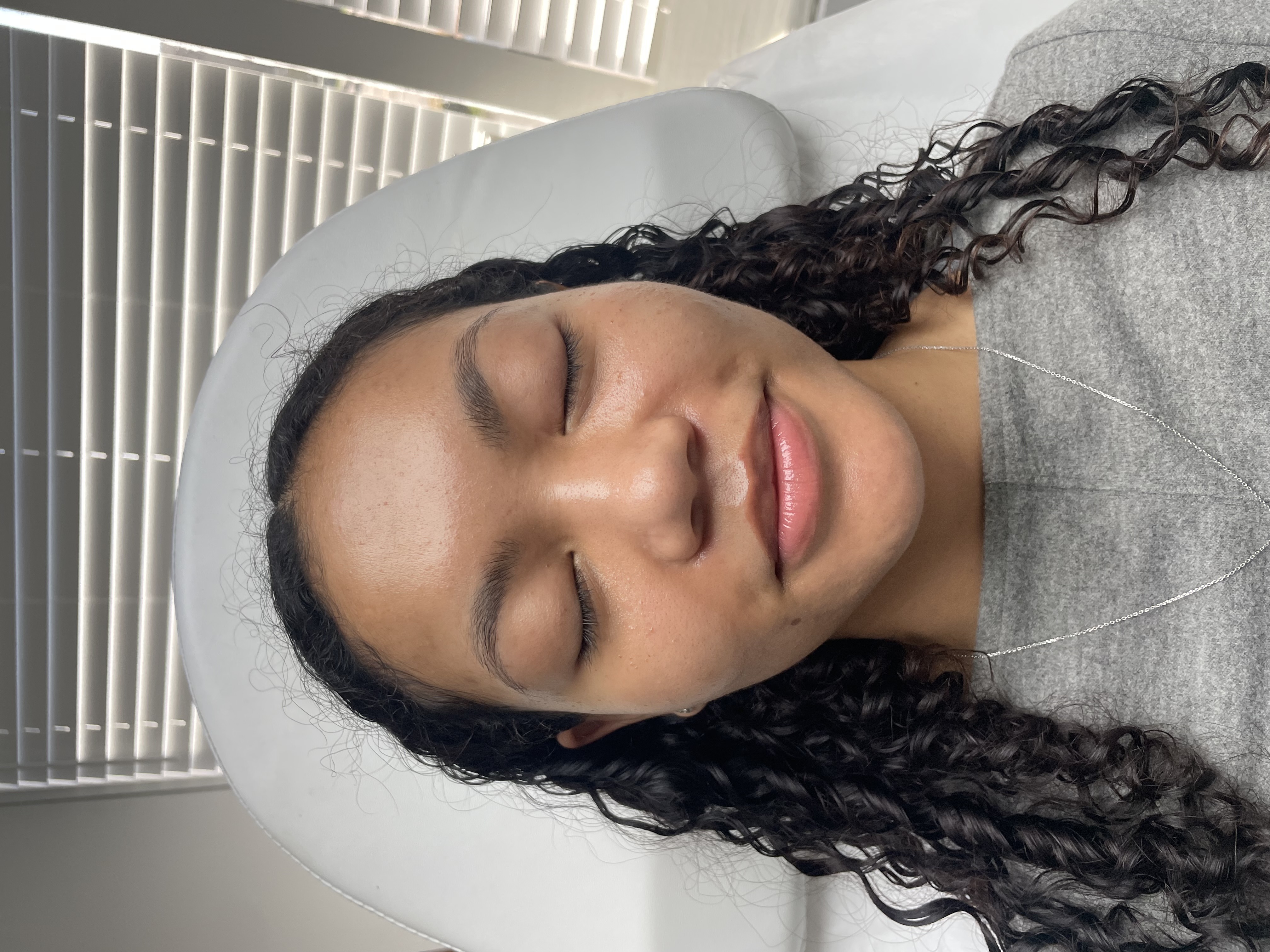 After HIFU skin clarity