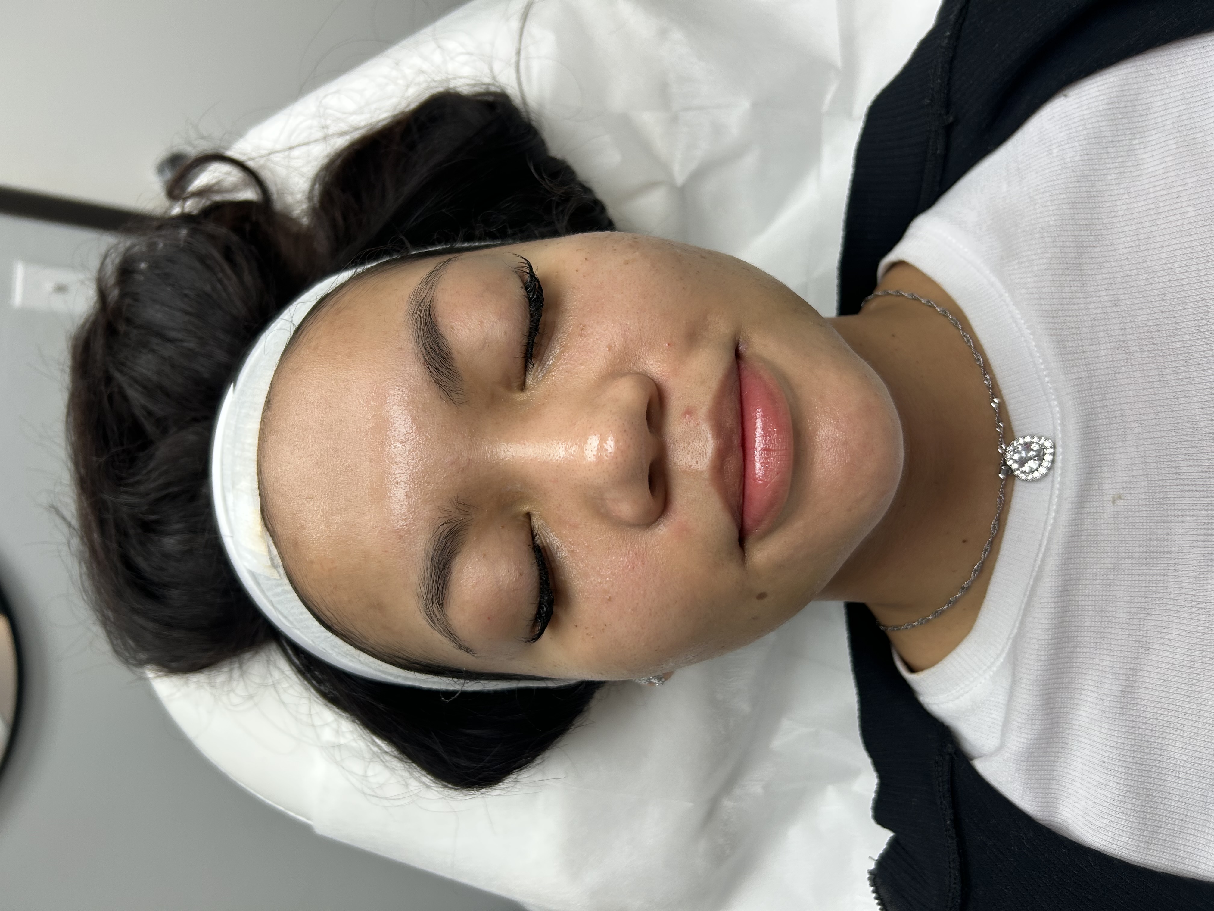 Before HIFU skin clarity