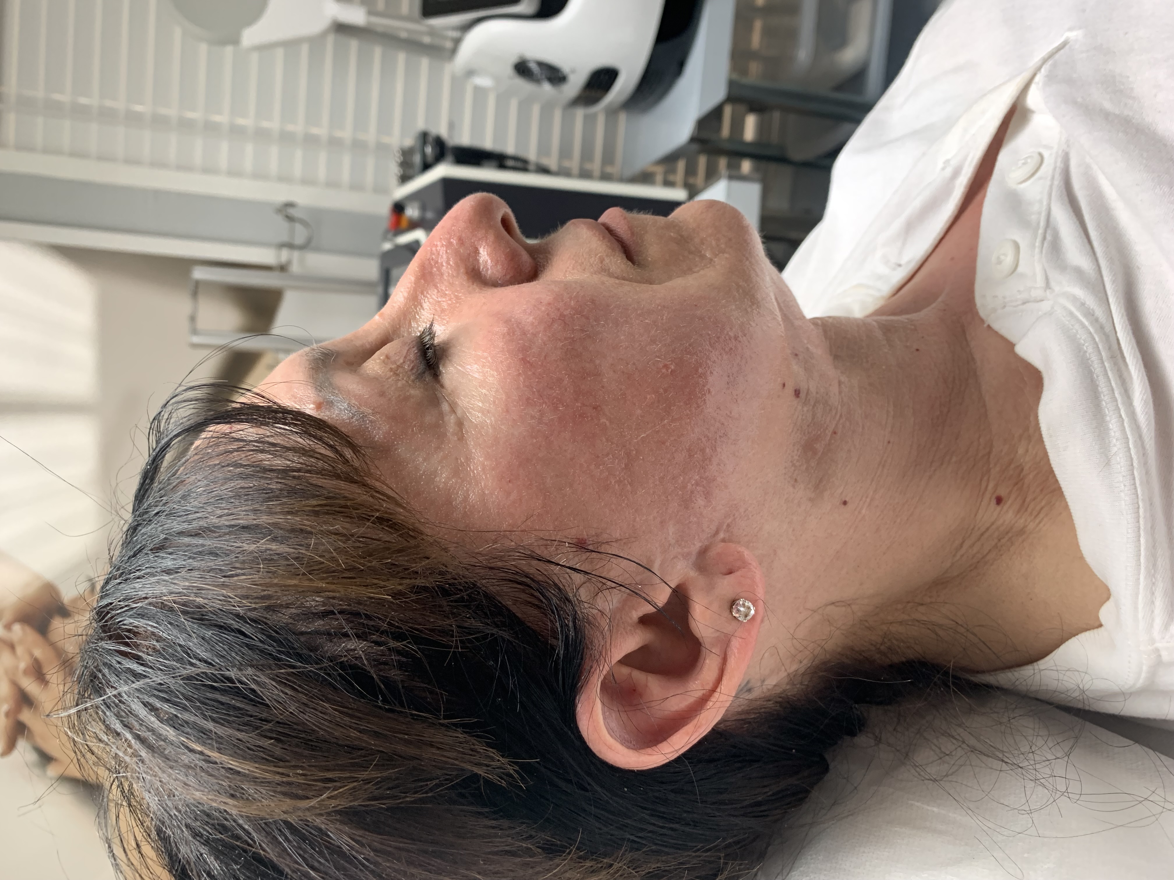 Before HIFU treatment at Skin Medical Spa