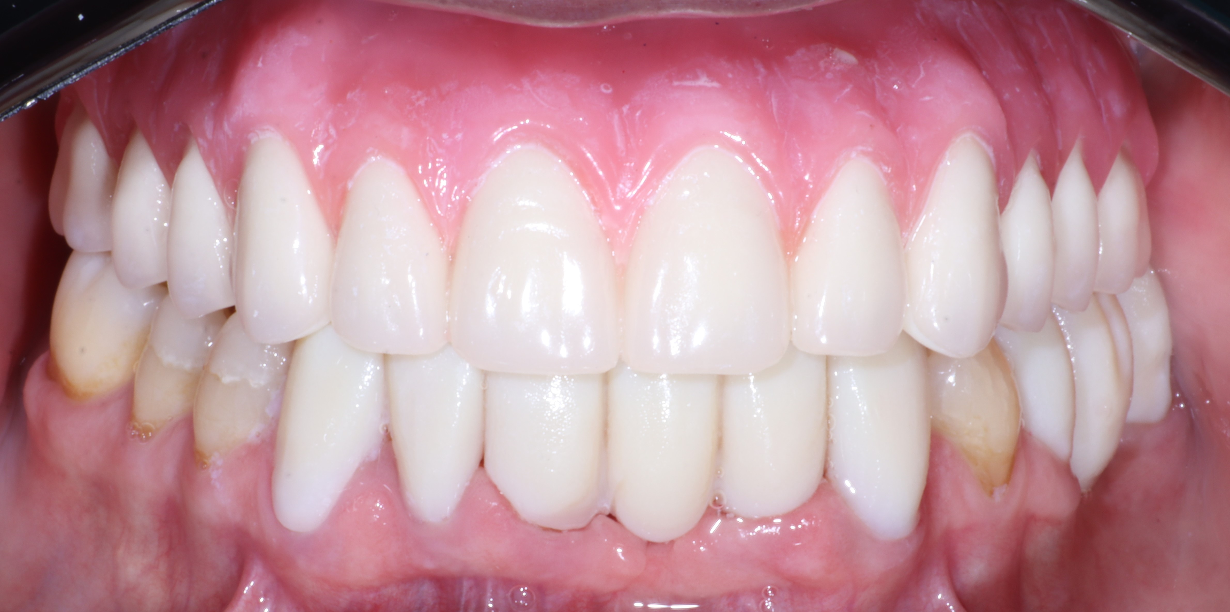 Rehabilitación full mouth, vista 3