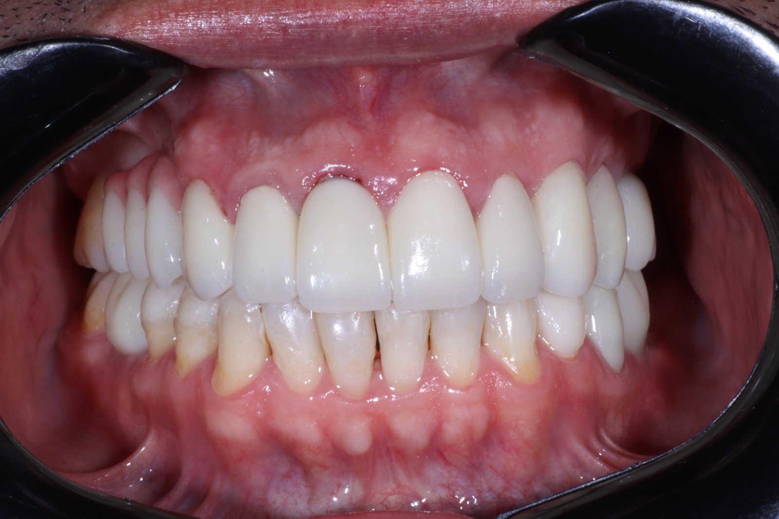 Rehabilitación full mouth, vista 1