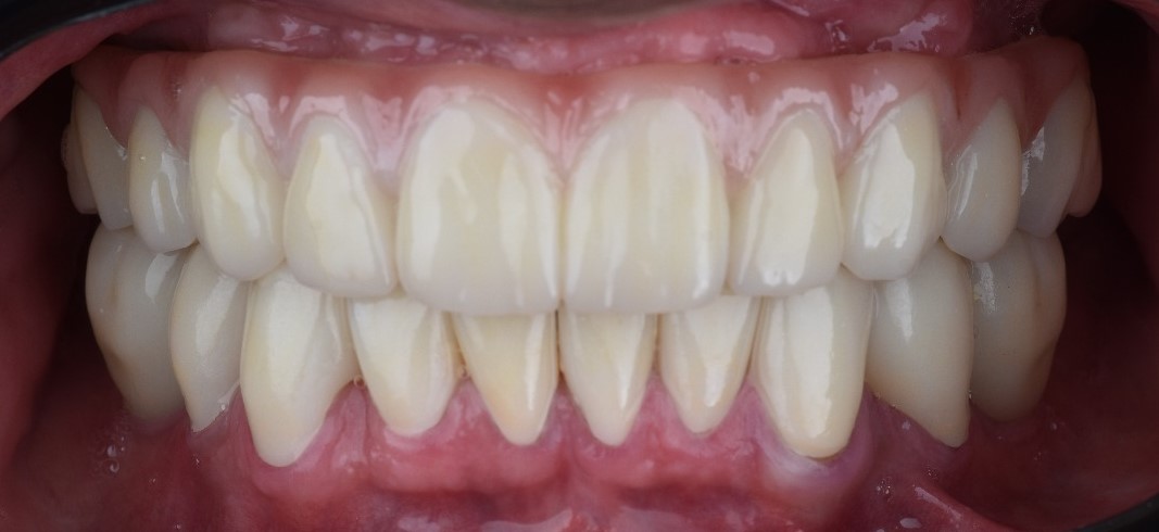 Rehabilitación oral completa