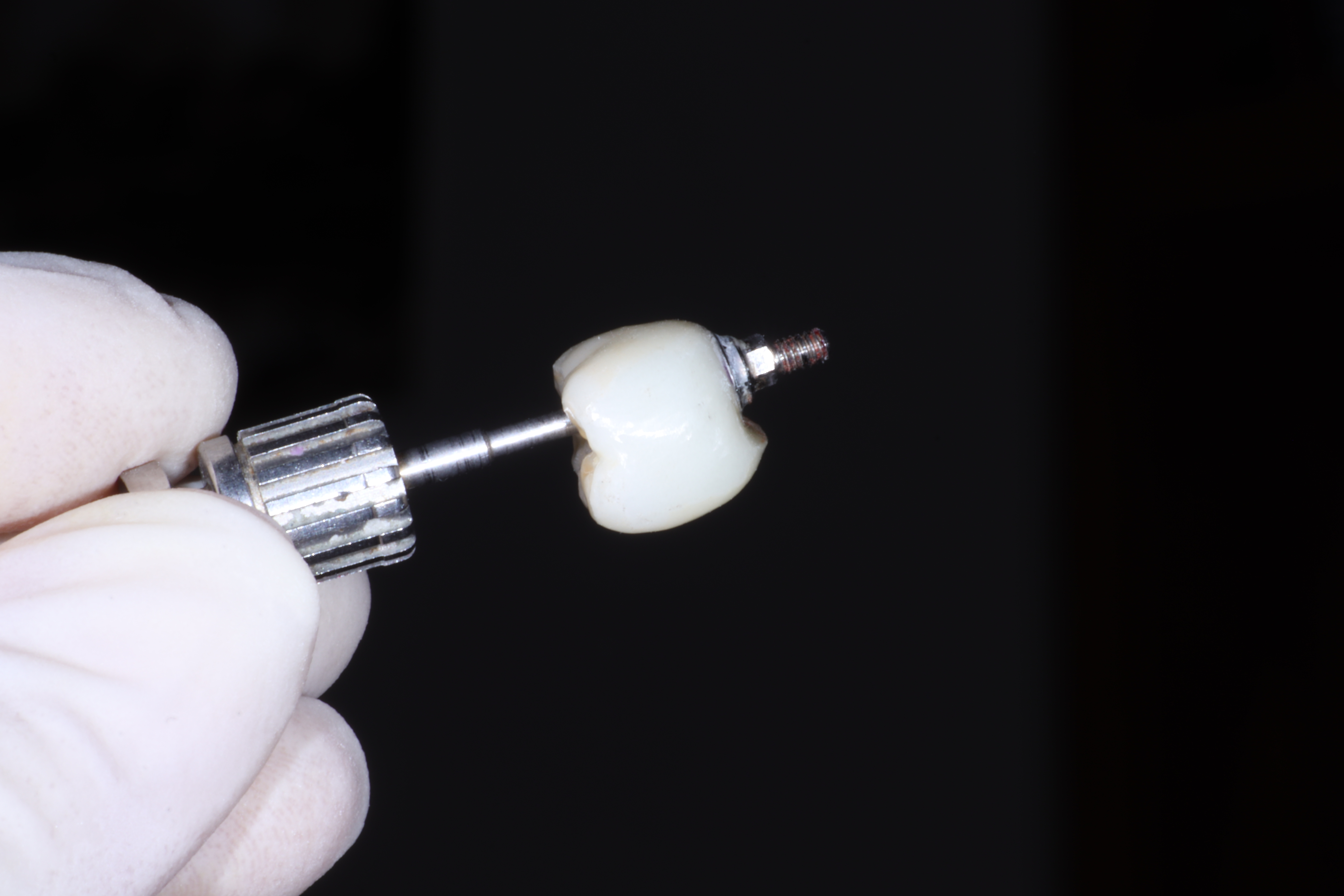 Prótesis sobre implantes unitarios
