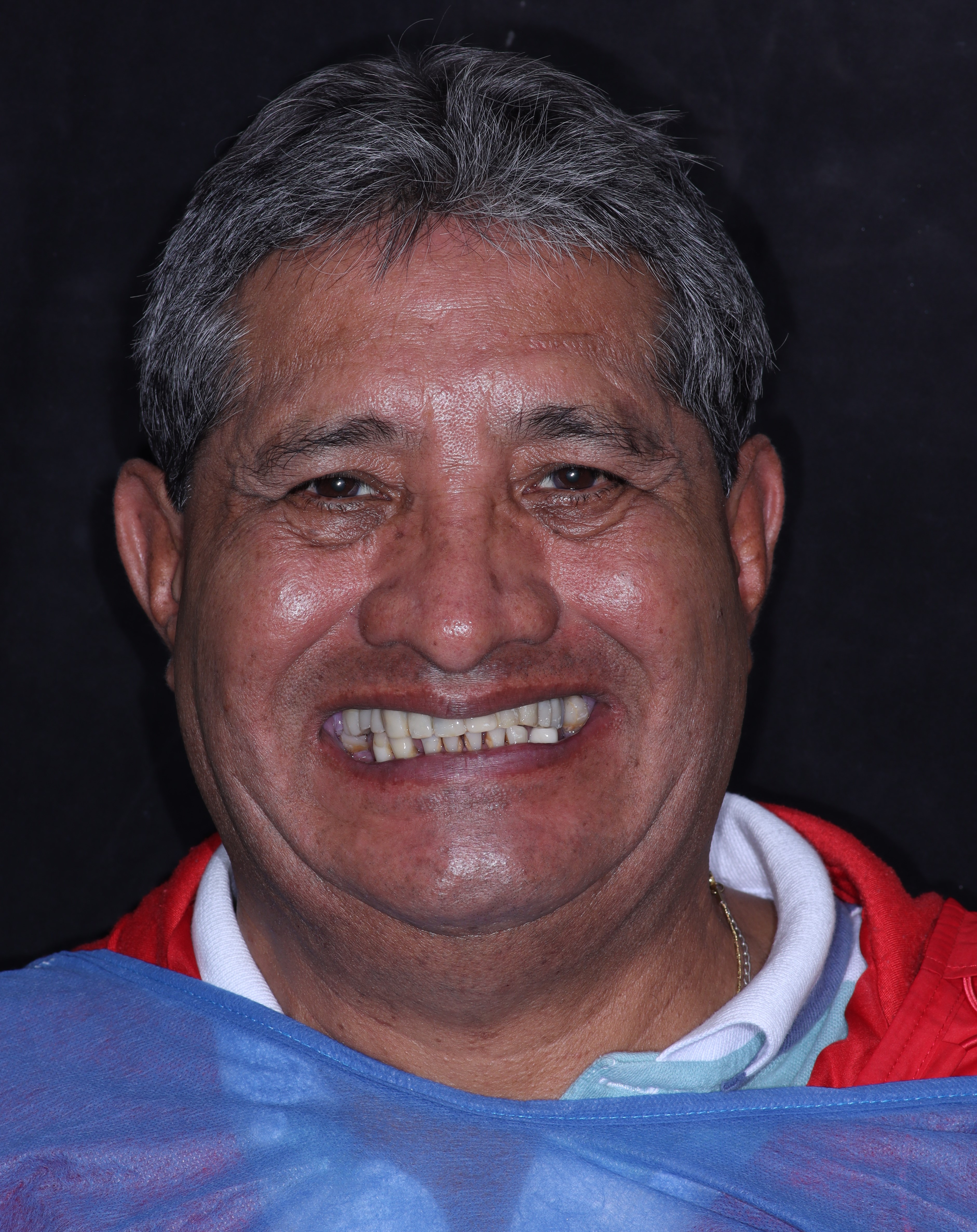 Antes del tratamiento: rostro completo