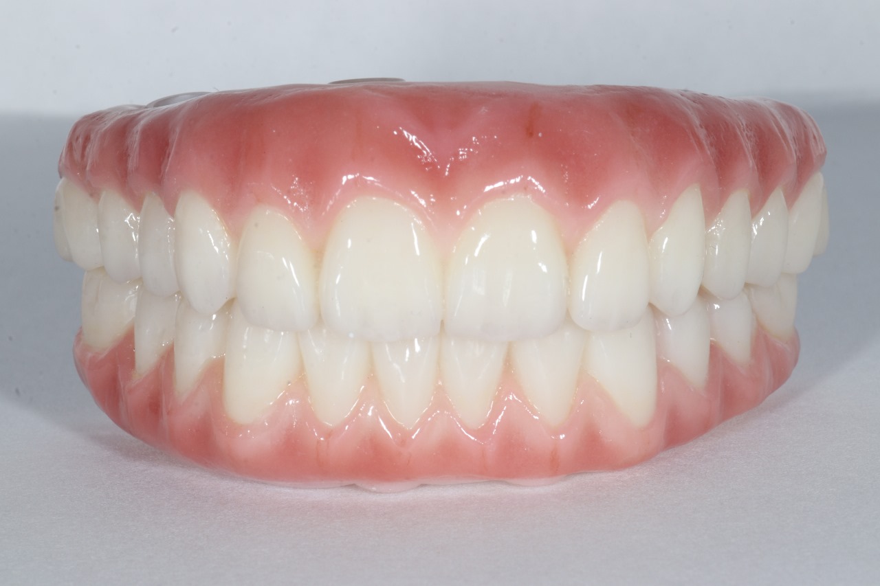 Dientes fijos sobre implantes de arco completo