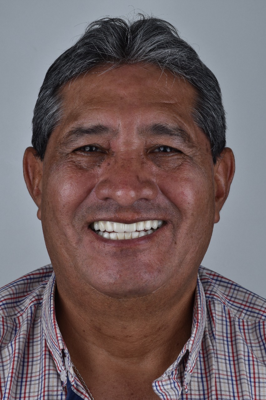 Después del tratamiento: rostro completo