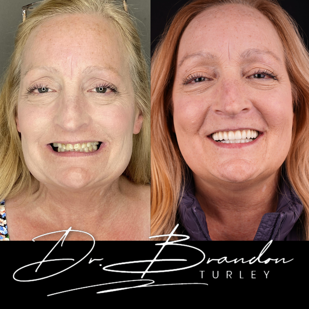 Before and after dental implant result