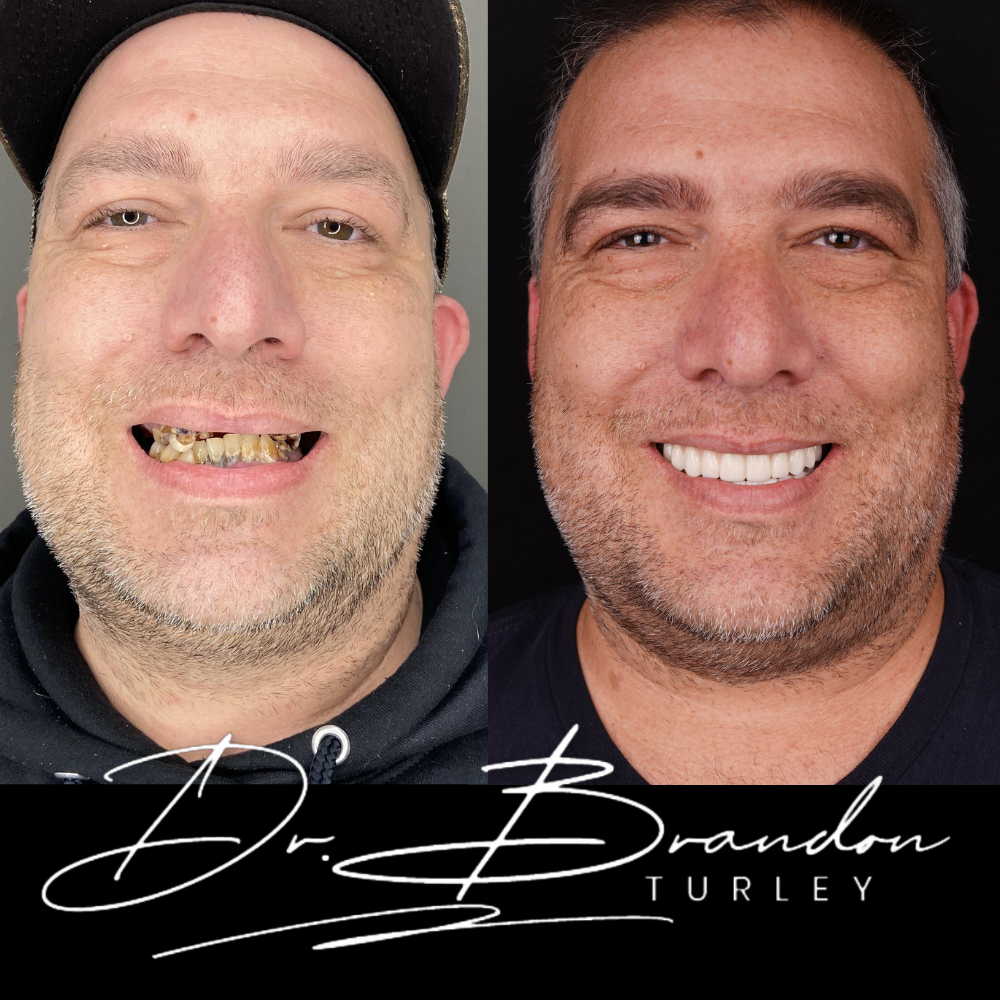 Before and after dental implant result