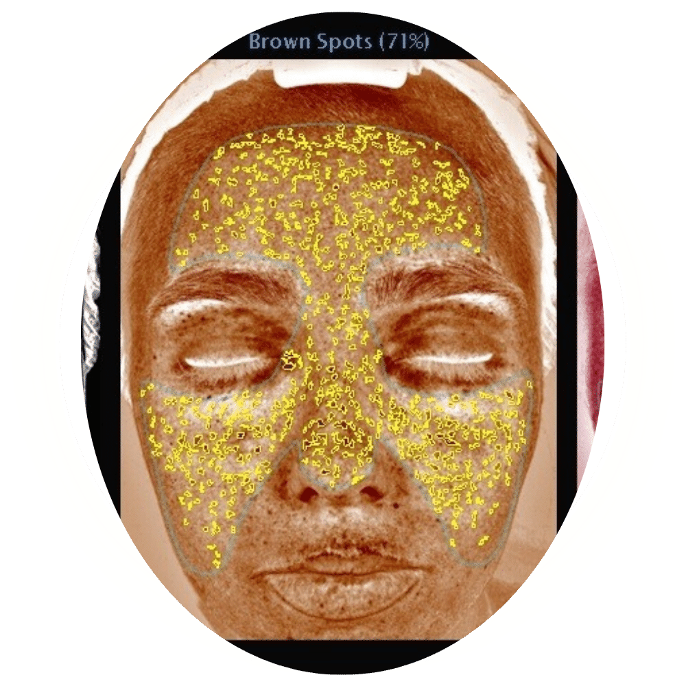 Skin Analysis 1