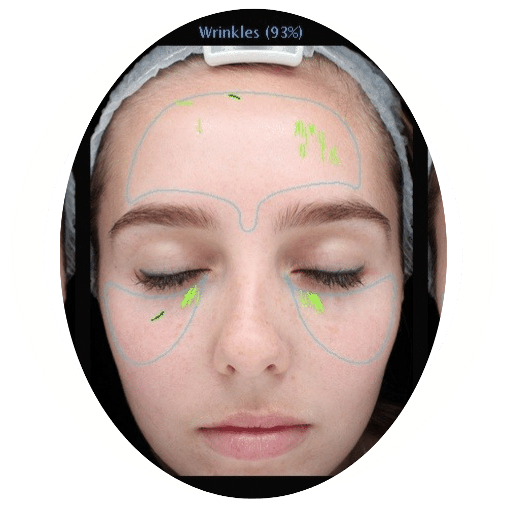 Skin Analysis 5