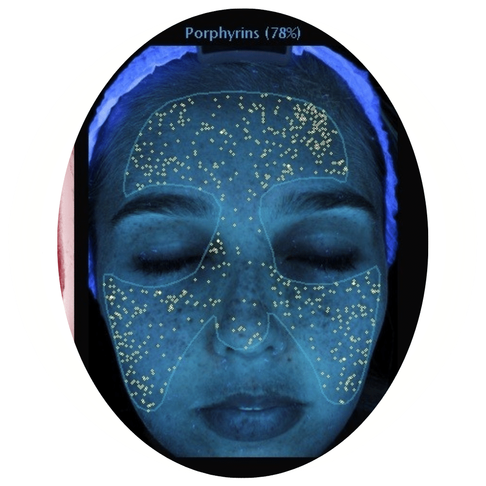 Skin Analysis 3