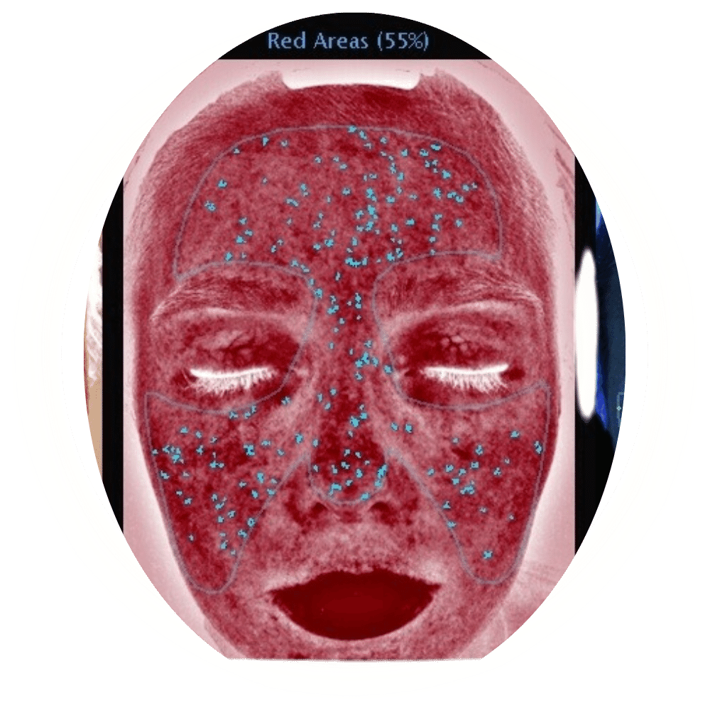 Skin Analysis 4