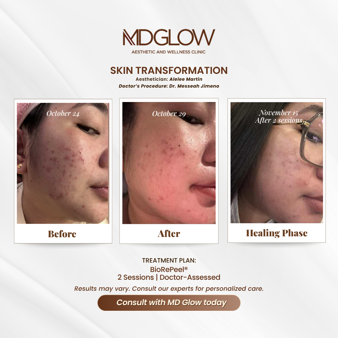 MD Glow Before and After Result
