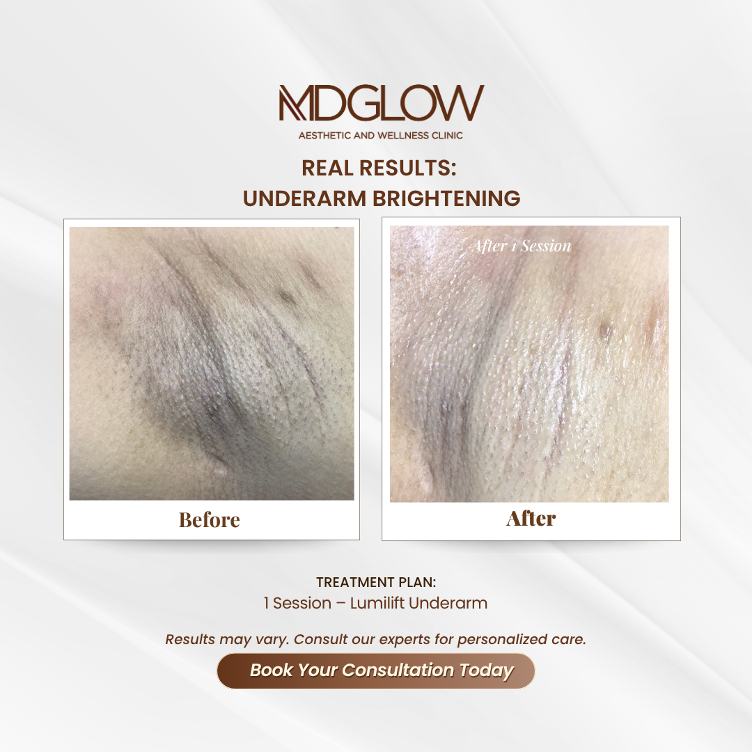 MD Glow Before and After Result