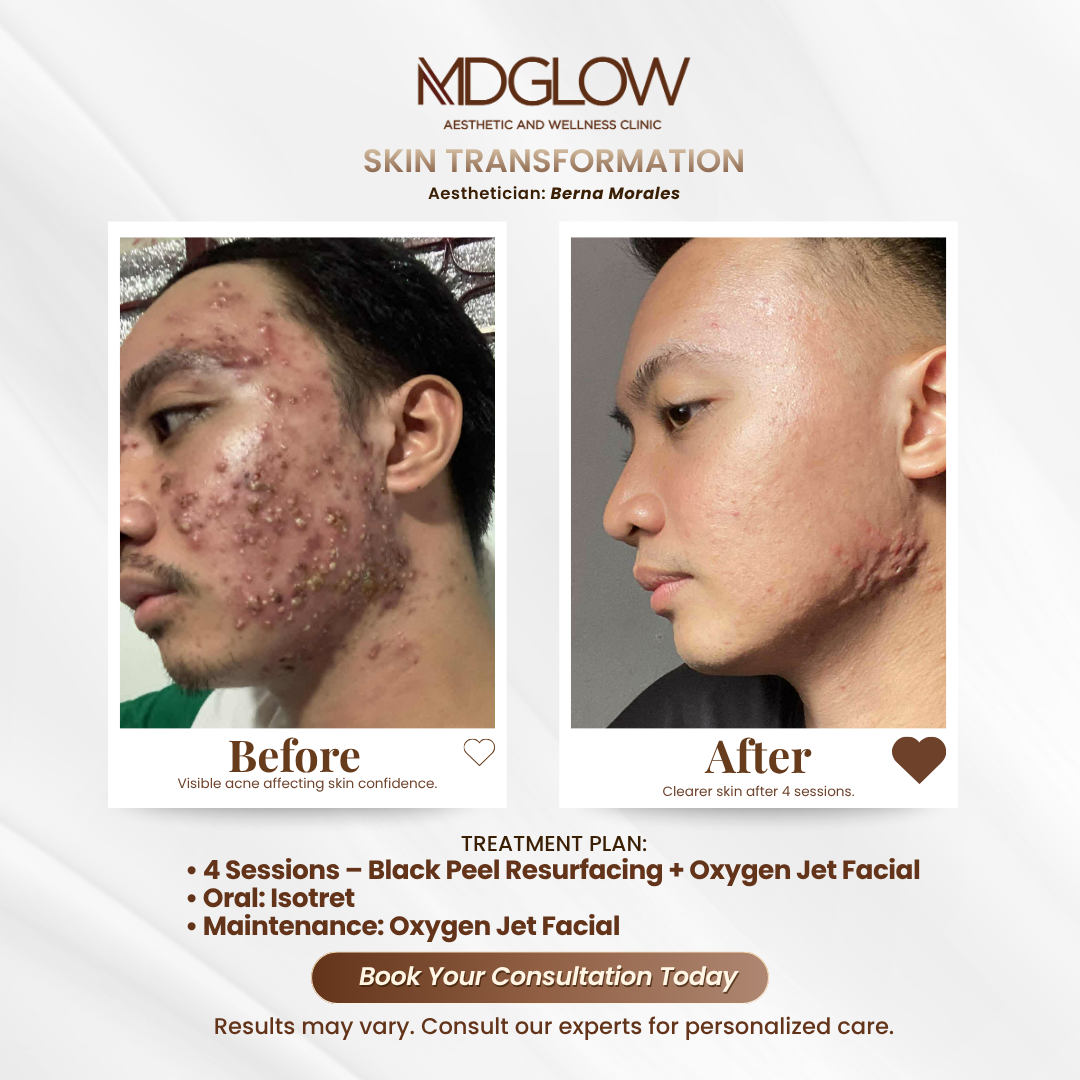 MD Glow Before and After Result