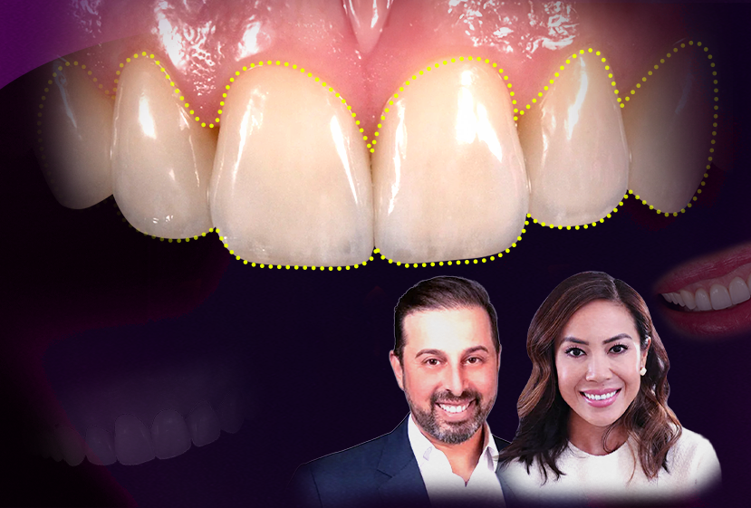 Veneer result by Dr. Amanda Seay and Dr. Adamo Notarantonio