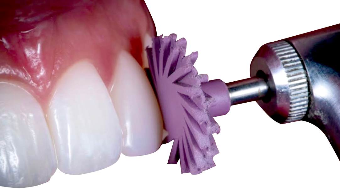 Black Triangle Closure and Papilla Prediction