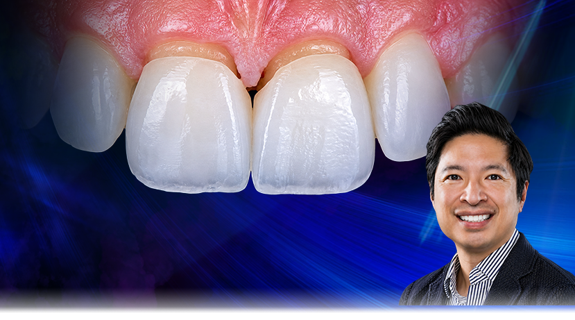 Free Veneer Masterclass with Dr. Gordon Chee