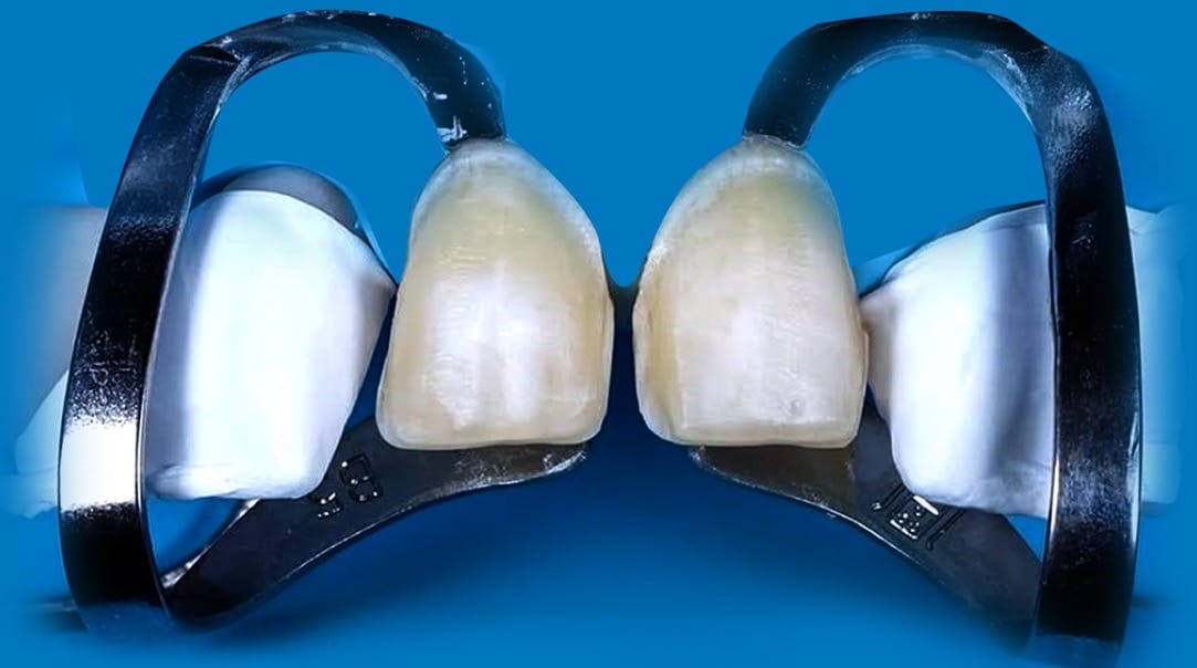 Preparation, tissue and provisionals