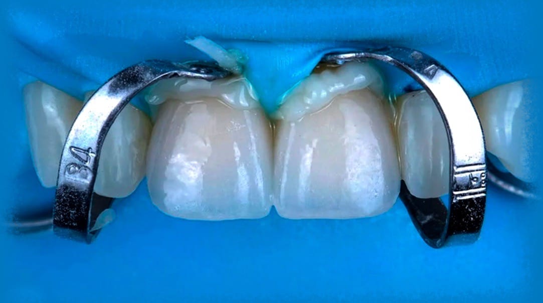 Ceramics, adhesion and delivery