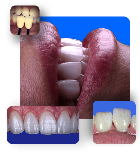 Veneer smile transformation from Dr. Gordon Chee's mentorship