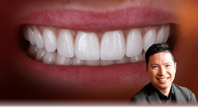 Veneer dentistry result from Dr. Gordon Chee's mentorship program