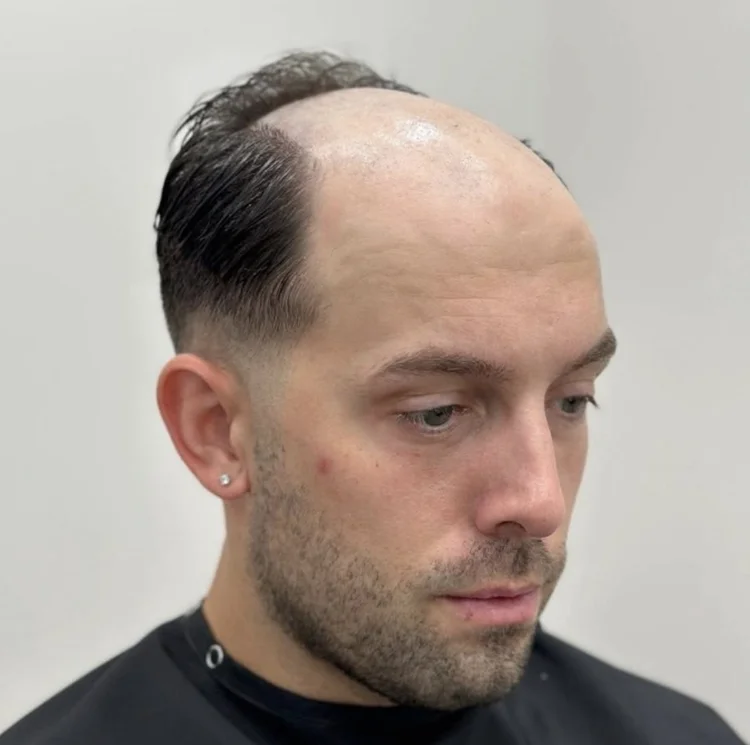 Before Savant hair system installation