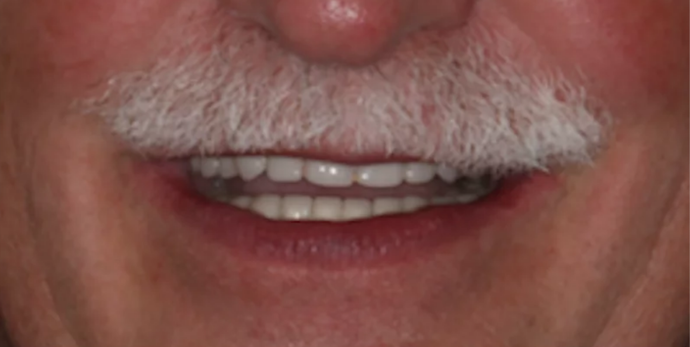 Patient smile after dental implant treatment