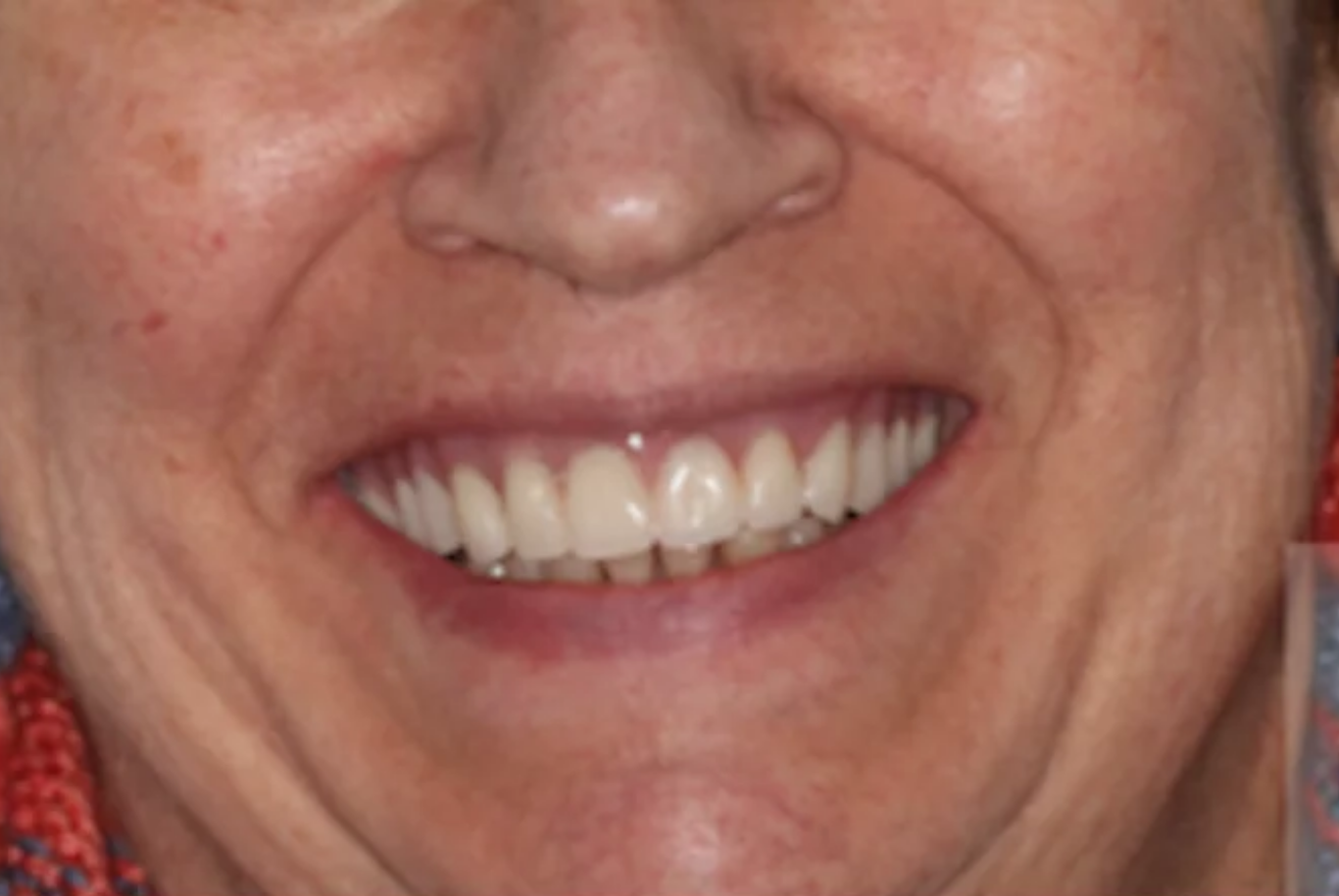 Patient smile after dental implant treatment