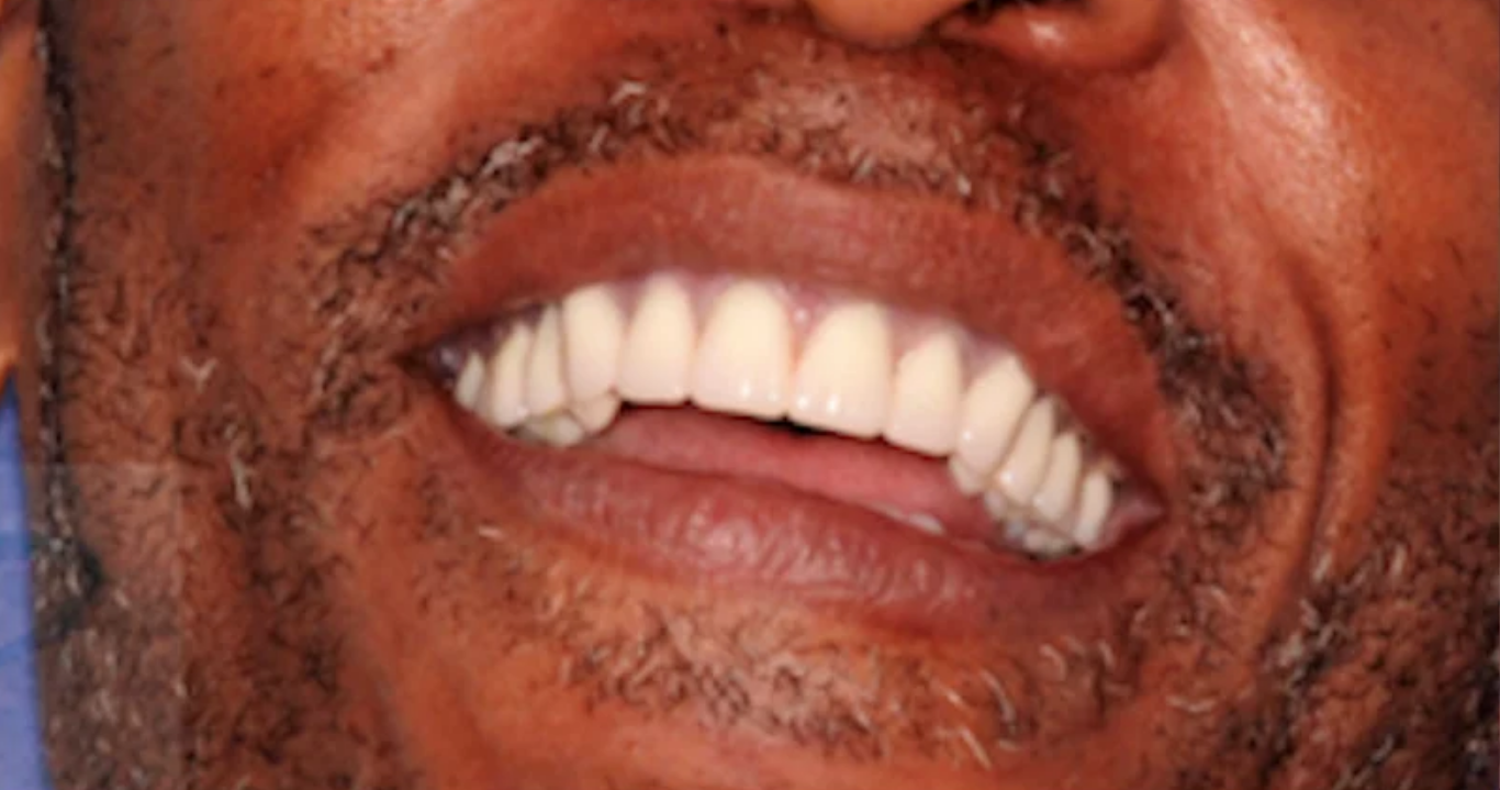 Patient smile after dental implant treatment