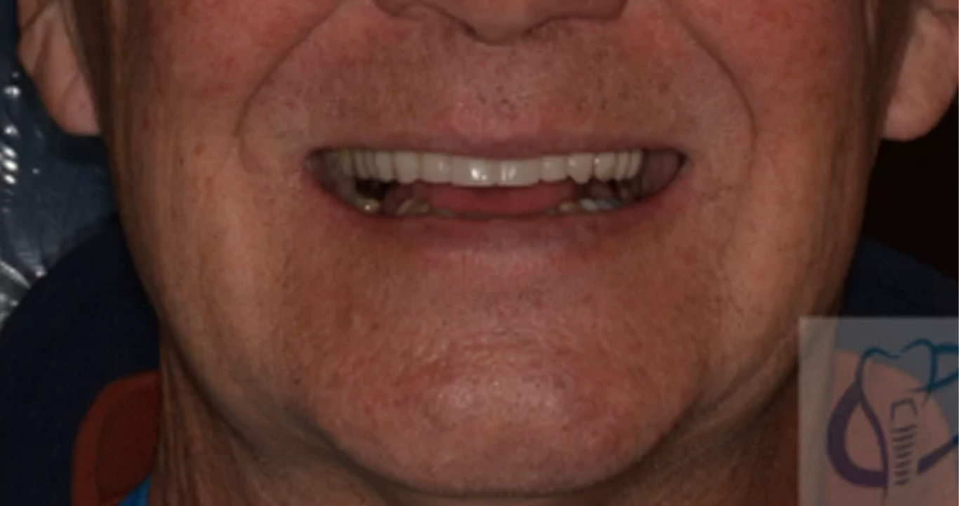 Patient smile after dental implant treatment