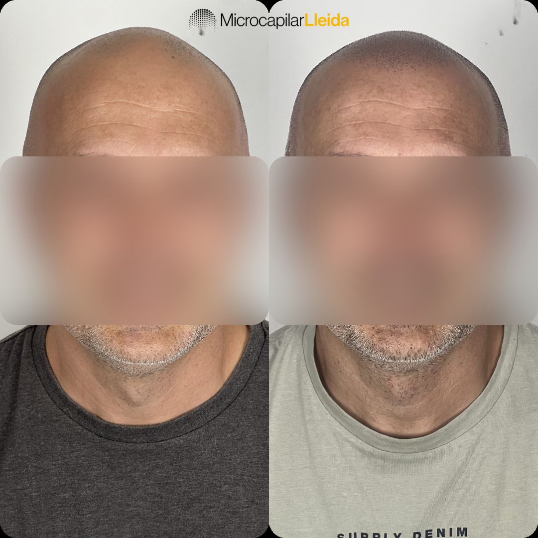 Caso de micropigmentación capilar antes y después en Lleida — caso 3