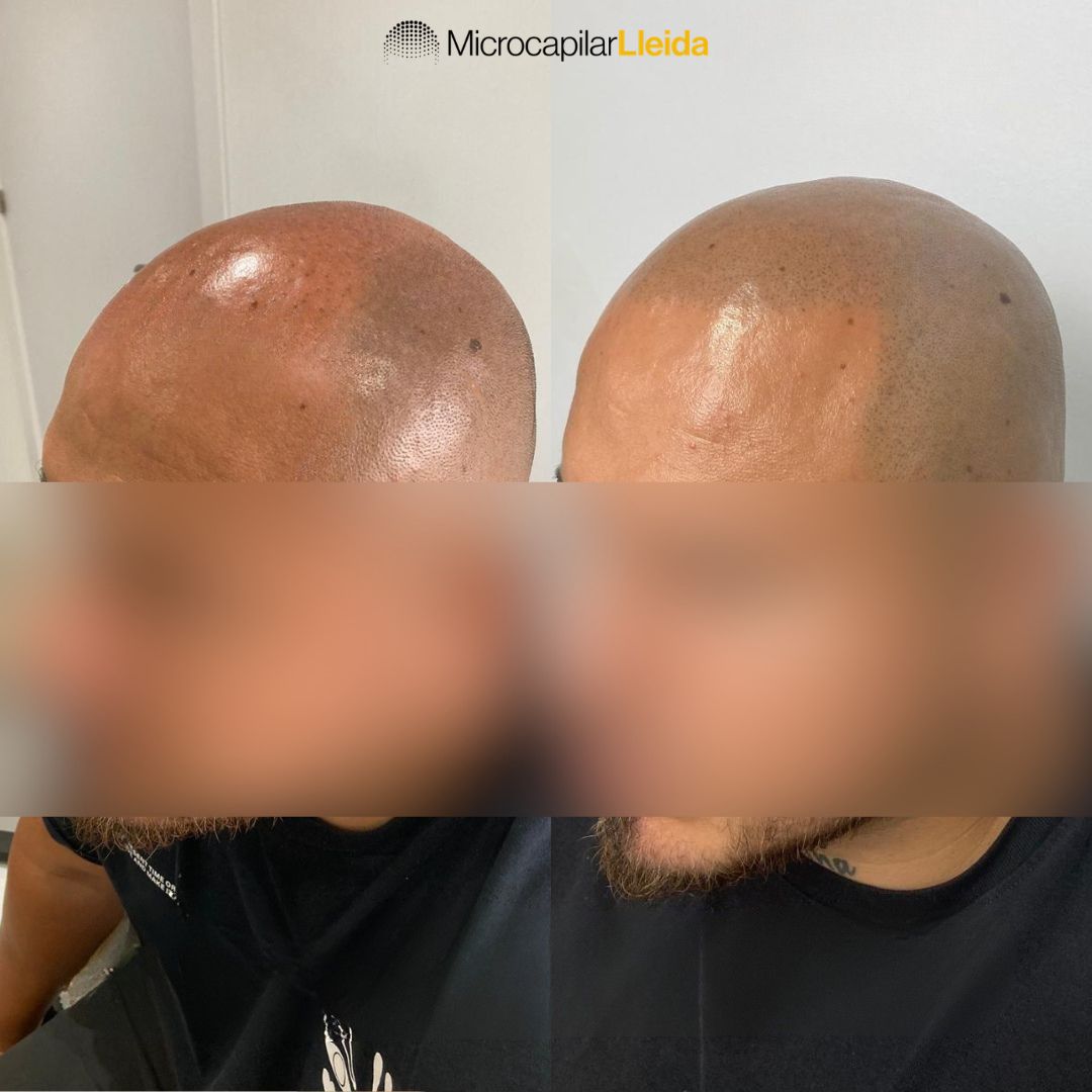 Resultado real de micropigmentación capilar