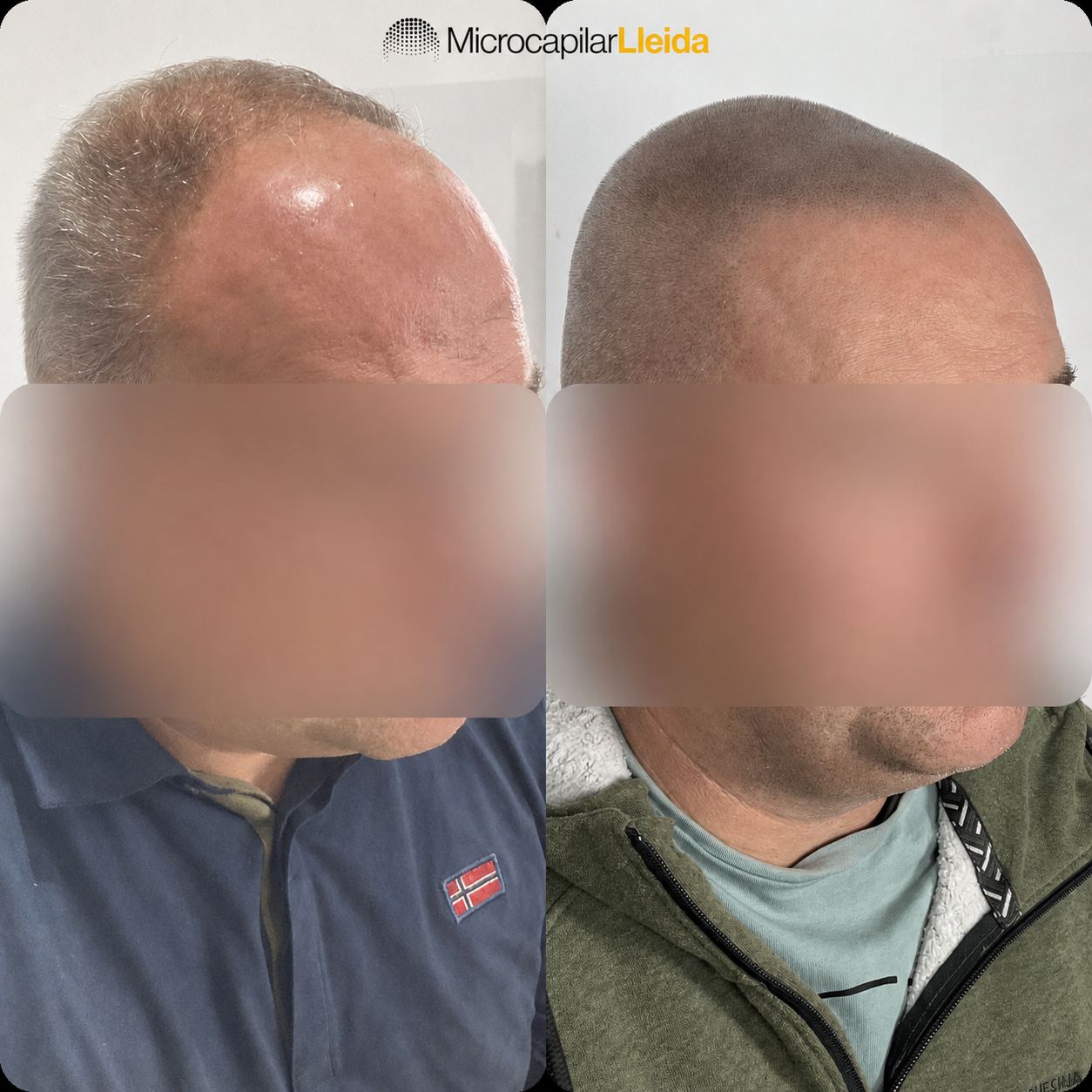Caso de micropigmentación capilar antes y después en Lleida — caso 1